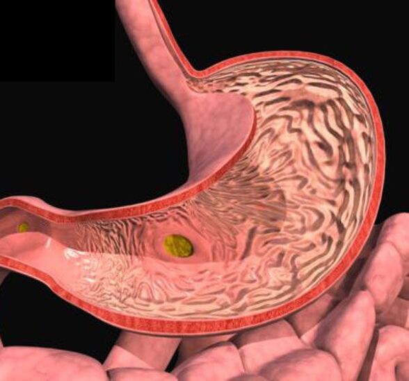 Bauch ulcer